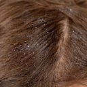 Agua tibia y otros remedios efectivos contra la caspa recomendados por profesionales