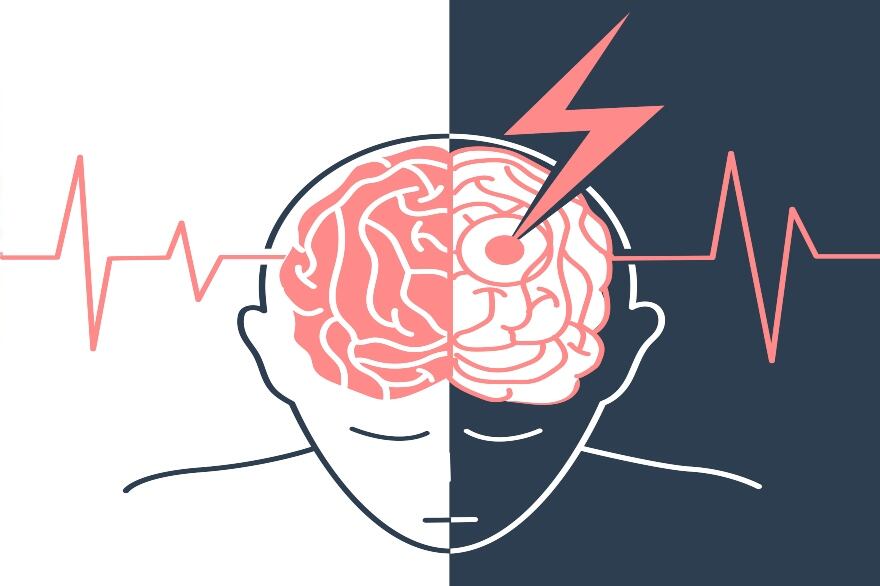 Los ataques cerebrovasculares se pueden presentar a cualquier edad, pero son más frecuentes en personas mayores de 50 años.
