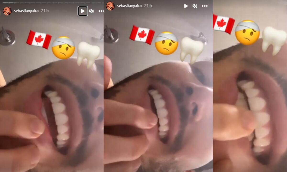 El artista señala que el diente se le 'chitió' tras el golpe auto infringido.