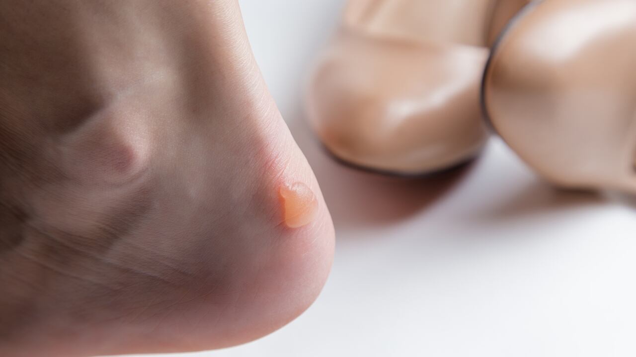 Una de las razones más frecuentes de la aparición de callosidades en los pies es el uso de calzado apretado.