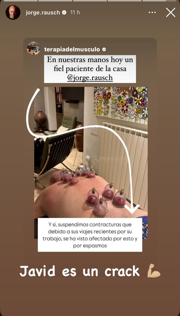 Jorge Rausch mostró cómo es el tratamiento de ventosas al que se sometió