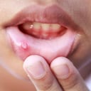 Las úlceras en la boca ocurren en algunos casos por infecciones.