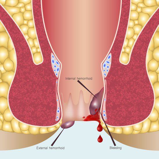Las hemorroides pueden generar graves y dolorosas ulceraciones.