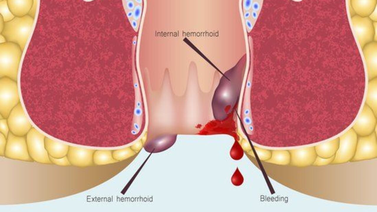 Las hemorroides pueden generar graves y dolorosas ulceraciones.