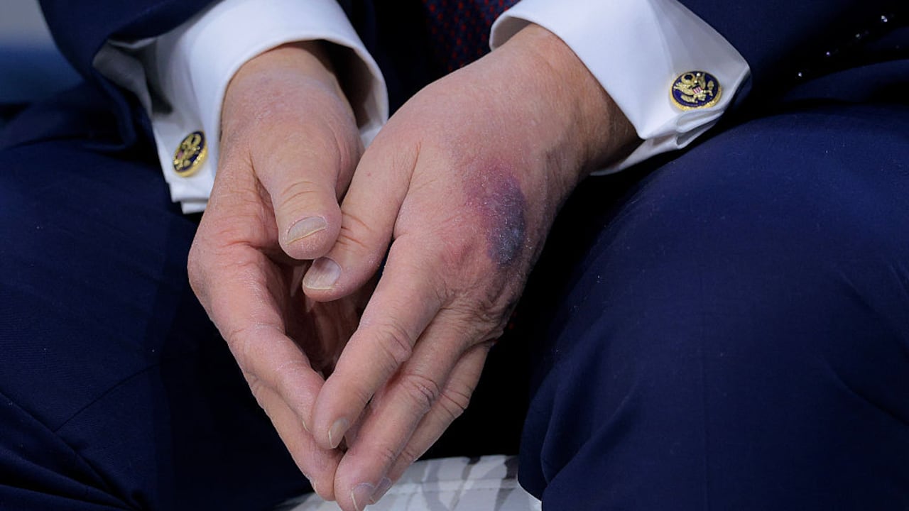 El presidente fue visto en un evento con la mano morada.