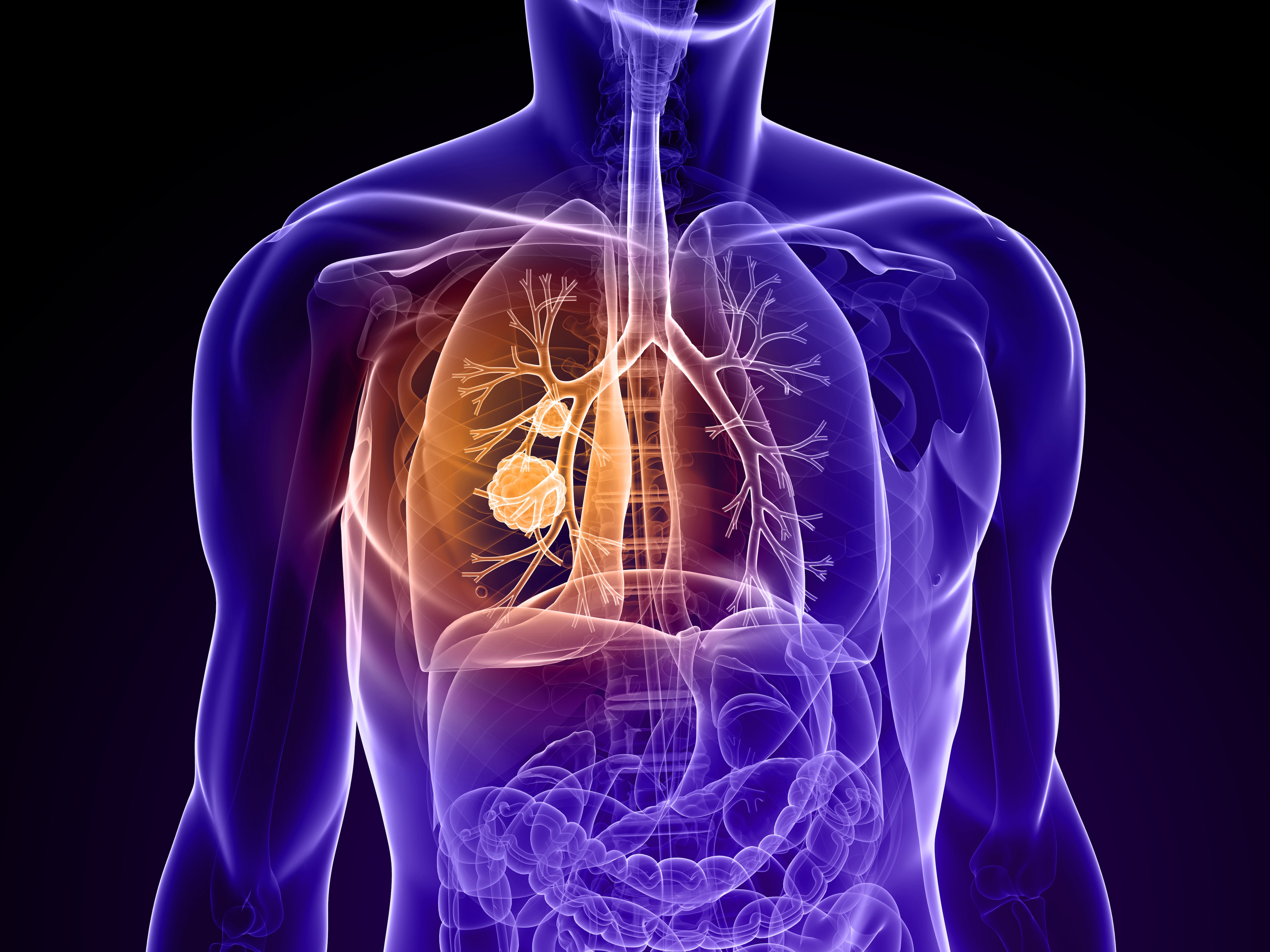 Cáncer de pulmón, pulmones