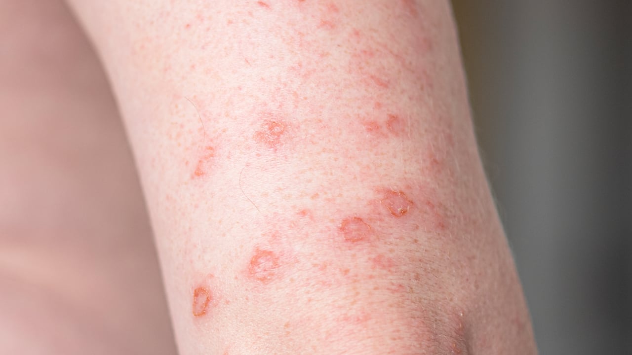 Sífilis: ¿cuáles son los síntomas y causas de esta enfermedad de transmisión sexual?