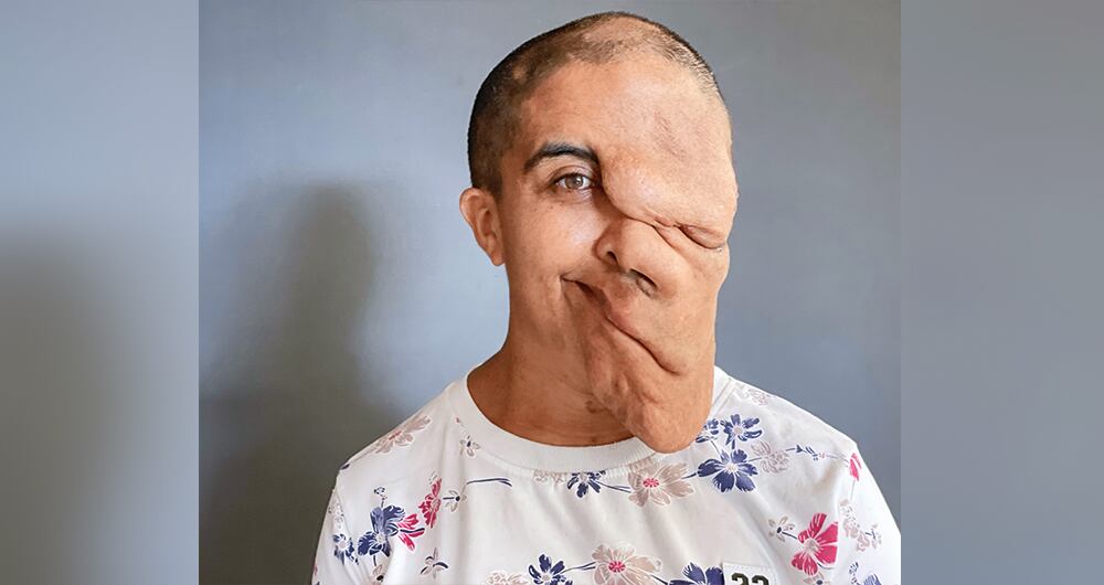   Sandra Milena Micán Castañeda lleva 30 años con tumores en el rostro, y será intervenida por el cirujano Juan Carlos Vélez Lara. La neurofibromatosis es una enfermedad poco común en Colombia.