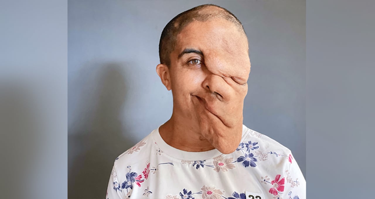 Sandra Milena Micán Castañeda lleva 30 años con tumores en el rostro, y será intervenida por el cirujano Juan Carlos Vélez Lara. La neurofibromatosis es una enfermedad poco común en Colombia.