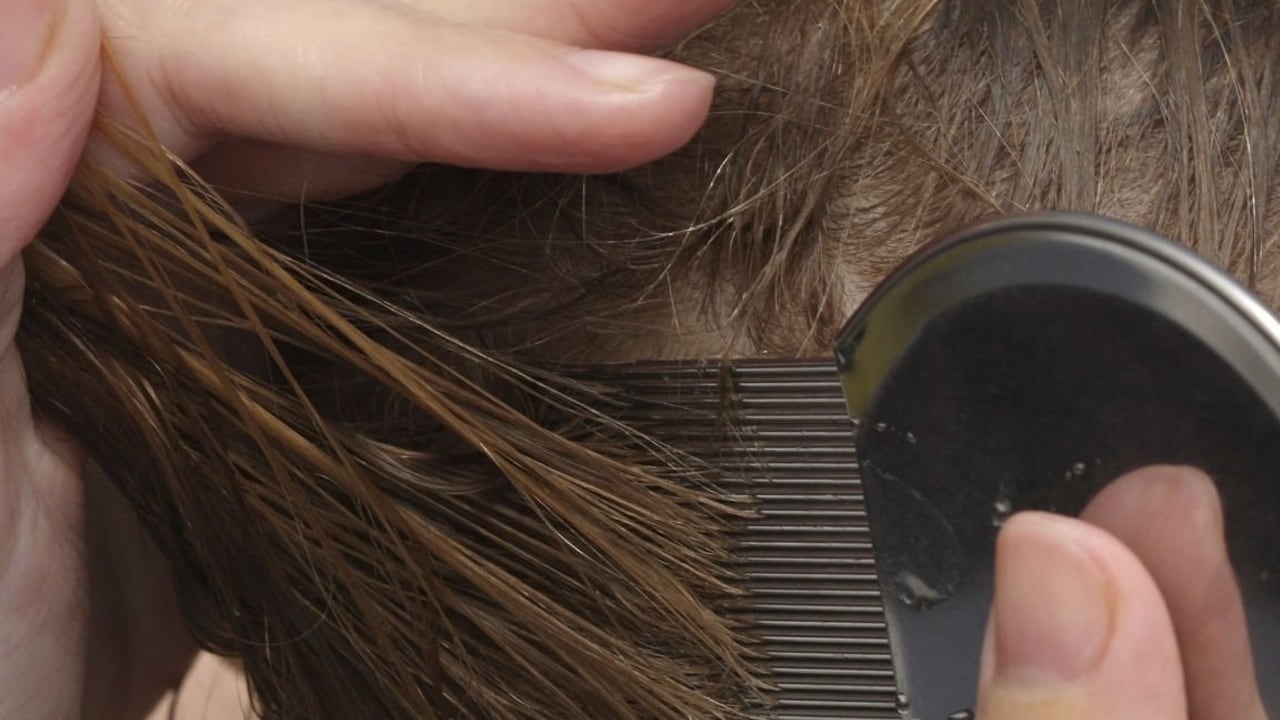 El vinagre es un ingrediente natural para acabar con los piojos