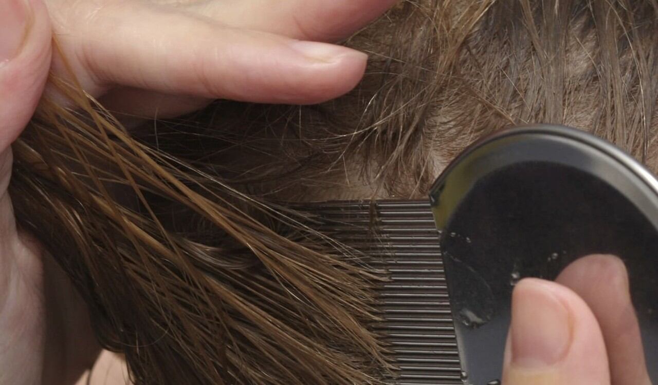 El vinagre es un ingrediente natural para acabar con los piojos