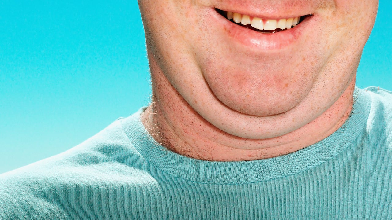 La papada puede convertirse en un problema estético por cuenta del exceso de grasa.