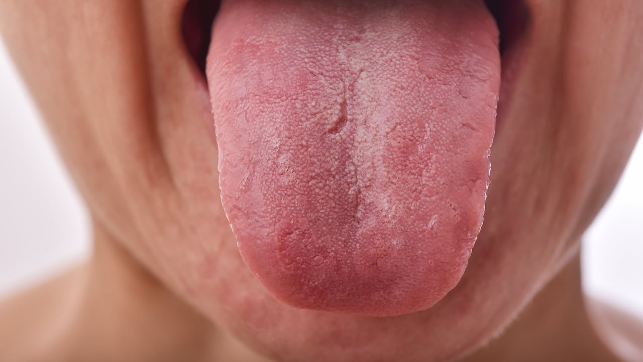 La xerostomía causa tener la lengua seca o con surcos.