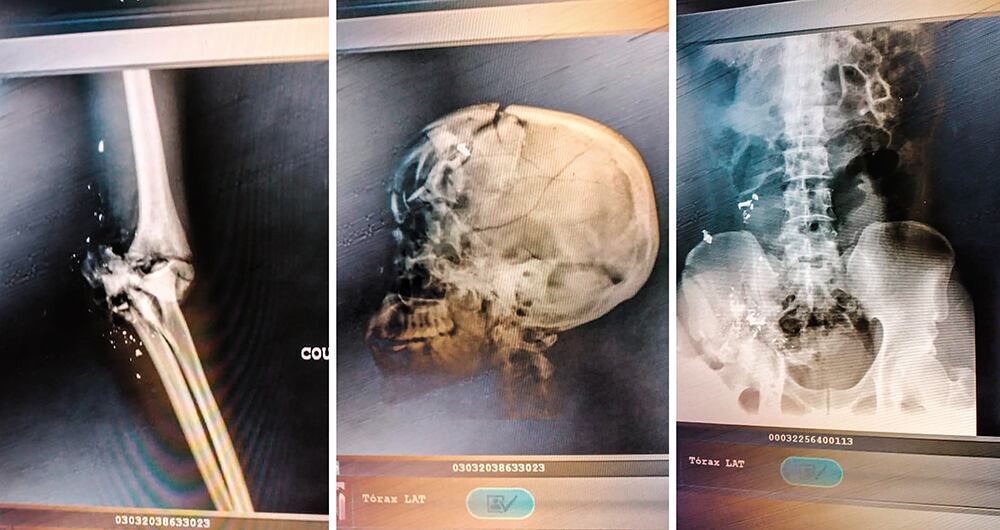 En medio de las balas, el presidente y su esposa se escondieron debajo de la cama, pero los asesinos vieron sus pies. Ella fue testigo del ensañamiento contra su marido, como lo revelan las radiografías del cuerpo. Recibió 12 disparos y sufrió varias fracturas por los golpes. 