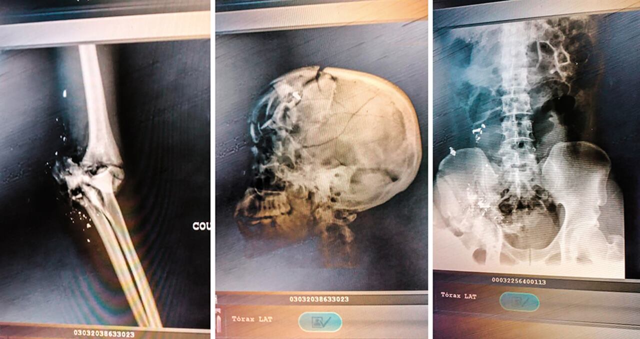 En medio de las balas, el presidente y su esposa se escondieron debajo de la cama, pero los asesinos vieron sus pies. Ella fue testigo del ensañamiento contra su marido, como lo revelan las radiografías del cuerpo. Recibió 12 disparos y sufrió varias fracturas por los golpes.