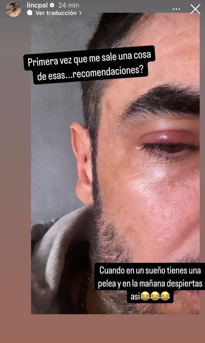 Lincoln Palomeque mostró que su rostro se vio afectado por un orzuelo