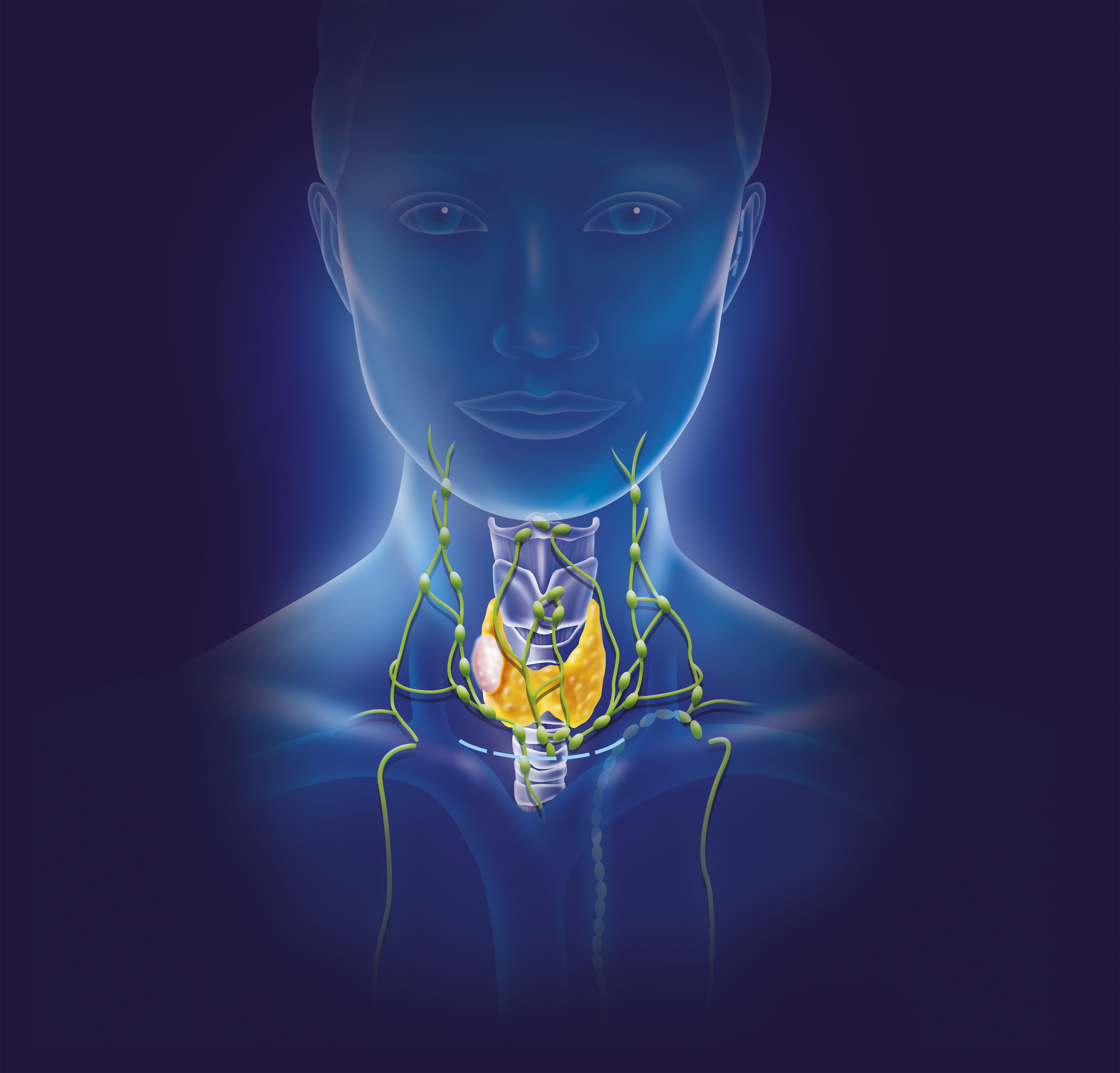 El linfoma es un tipo de cáncer del sistema linfático, que es parte de la red del organismo que combate los gérmenes. Uno de los síntomas es hinchazón indolora de los ganglios linfáticos en el cuello, las axilas o la ingle.