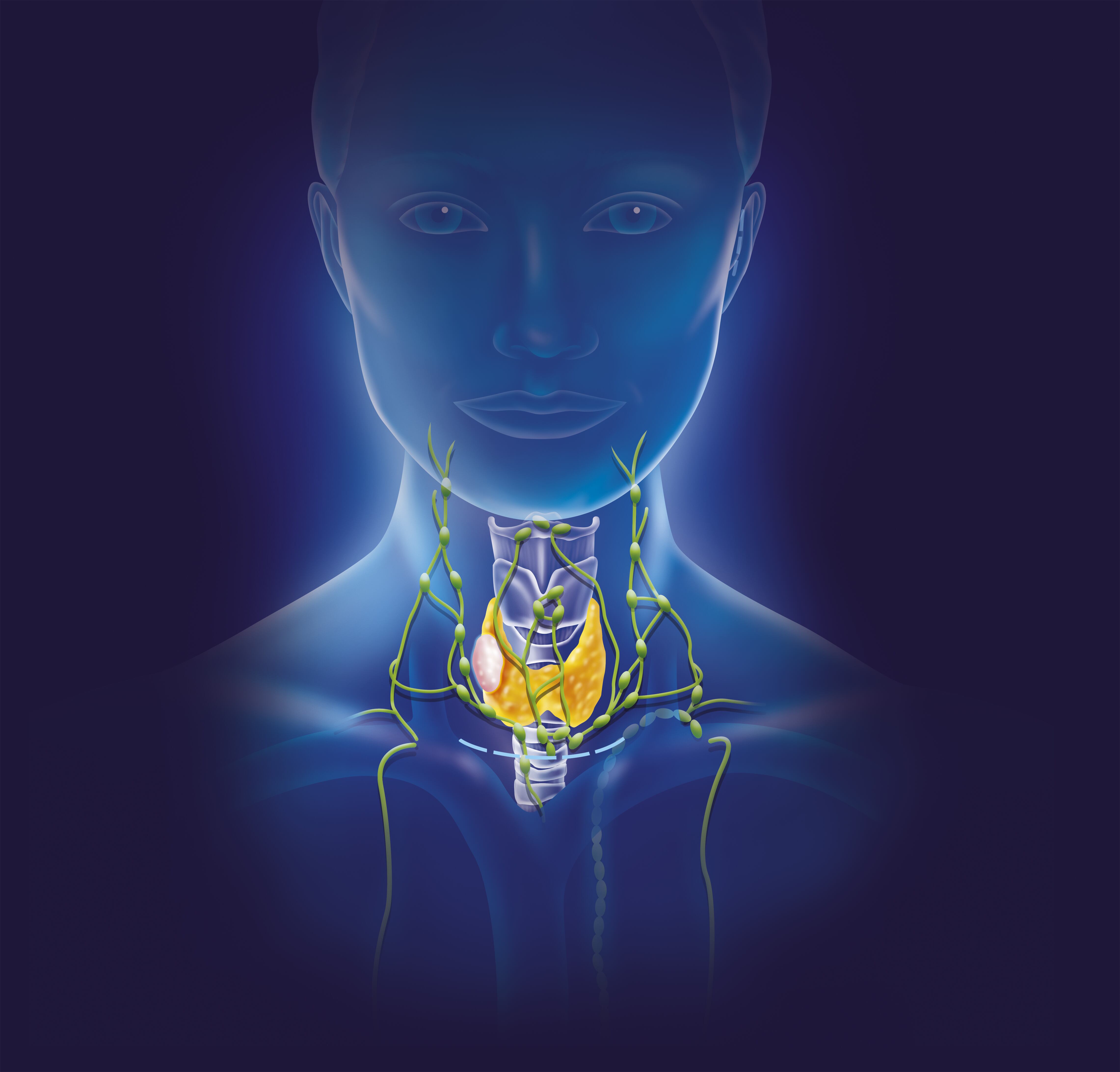 El linfoma es un tipo de cáncer del sistema linfático, que es parte de la red del organismo que combate los gérmenes. Uno de los síntomas es hinchazón indolora de los ganglios linfáticos en el cuello, las axilas o la ingle.