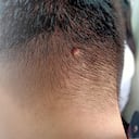 healthy problem."nThe small size of mole on occipital of the asian man