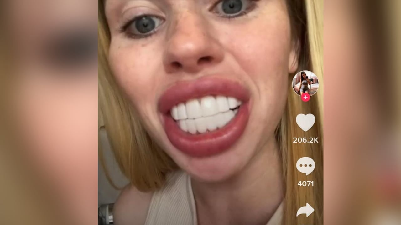 Una mujer denuncia que después de un procedimiento dental estético quedó como un caballo. Imagen de cuenta de tik tok @Lorenx