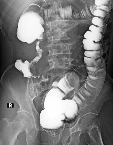 Un Enema es el procedimiento de introducir líquidos en el recto y el colon.