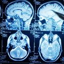 A pesar de que el tratamiento precoz de los tumores cerebrales puede mejorar los resultados, los pacientes deben informar a su médico de cualquier síntoma neurológico inusual.