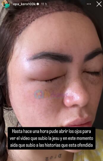 Epa Colombia sorprendió a sus seguidores con impresionantes fotos tras realizarse un implante capilar.