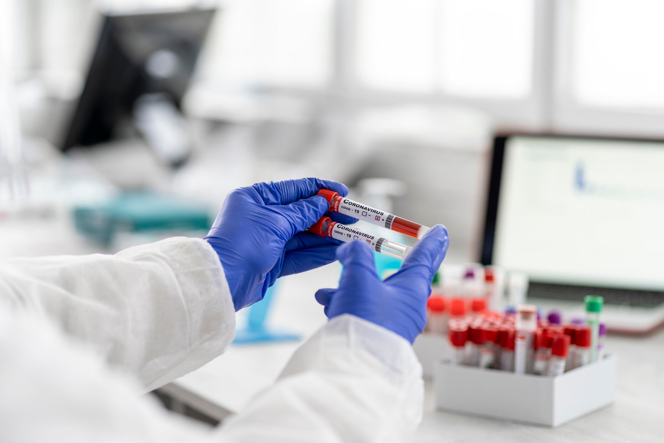 Foto de referencia sobre análisis de muestras de sangre