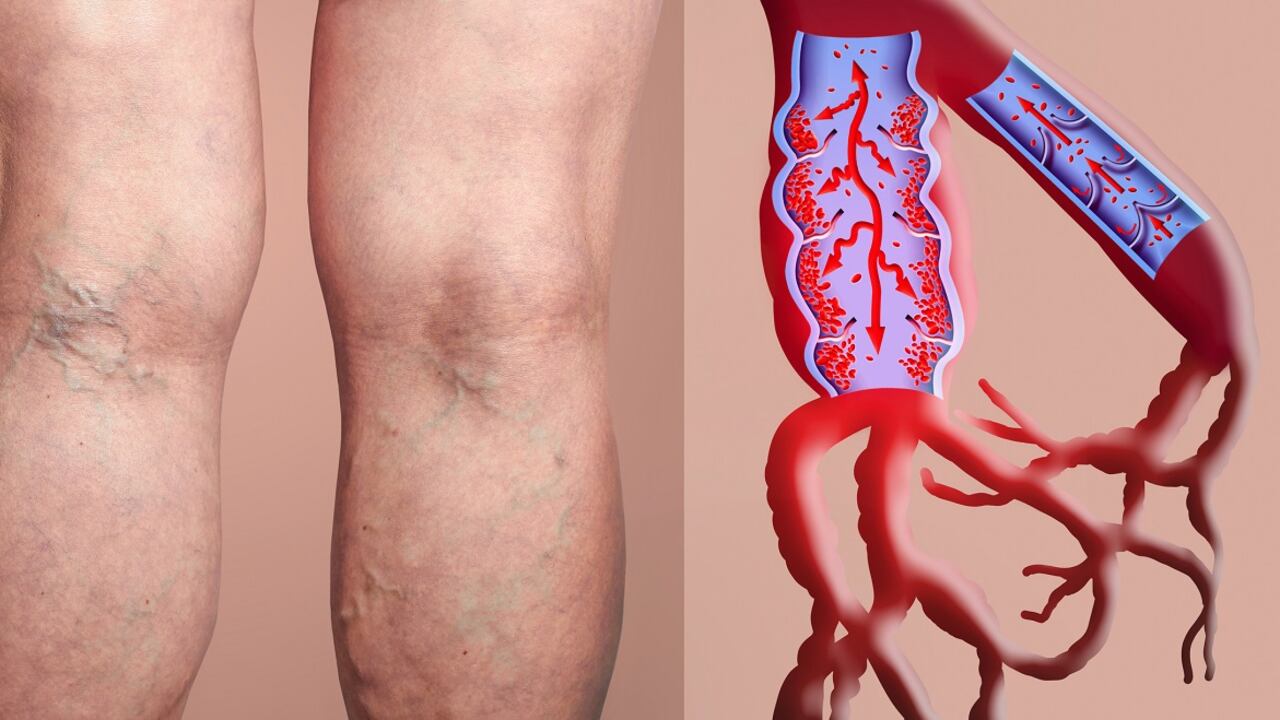 La mala circulación en las piernas puede ocasionar coágulos. Los grupos sanguíneo A y B son los más propensos a enfrentar esta afección.