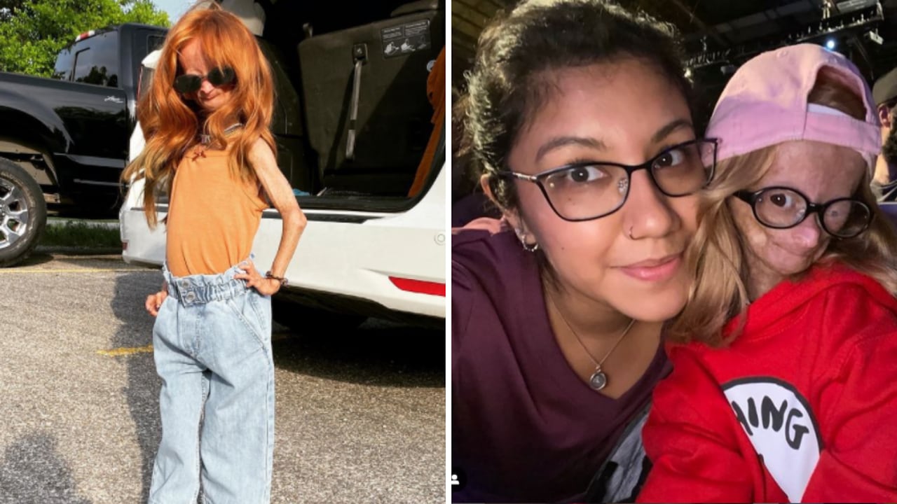 La youtuber estadounidense padecía una enfermedad rara cuyo nombre técnico es Hutchinson-Gilford progeria, pero se conoce como el síndrome de Benjamin Button.