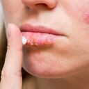 Young woman with cold sore applying cream on lips. Treatment of herpes infection and virus with ointment. Selective focus.
