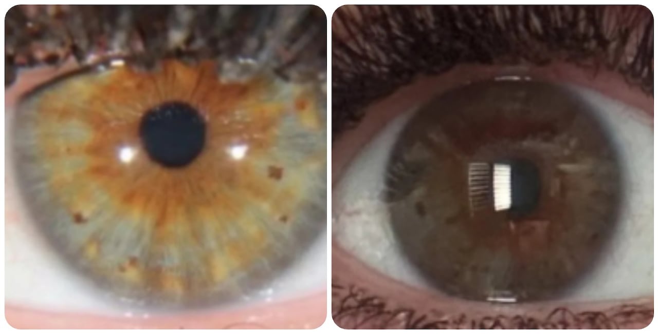 Los ojos de la mujer habrían cambiado de color después de ser impactada por un rayo