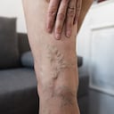 Close-up of varicose veins on woman leg