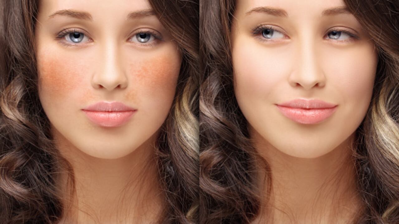 Se trata de una condición cutánea que se da por diversas razones.