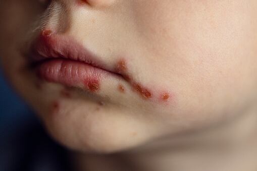 Las consecuencias del papiloma humano en la boca.