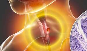 Cáncer de esófago, silencioso y mortal