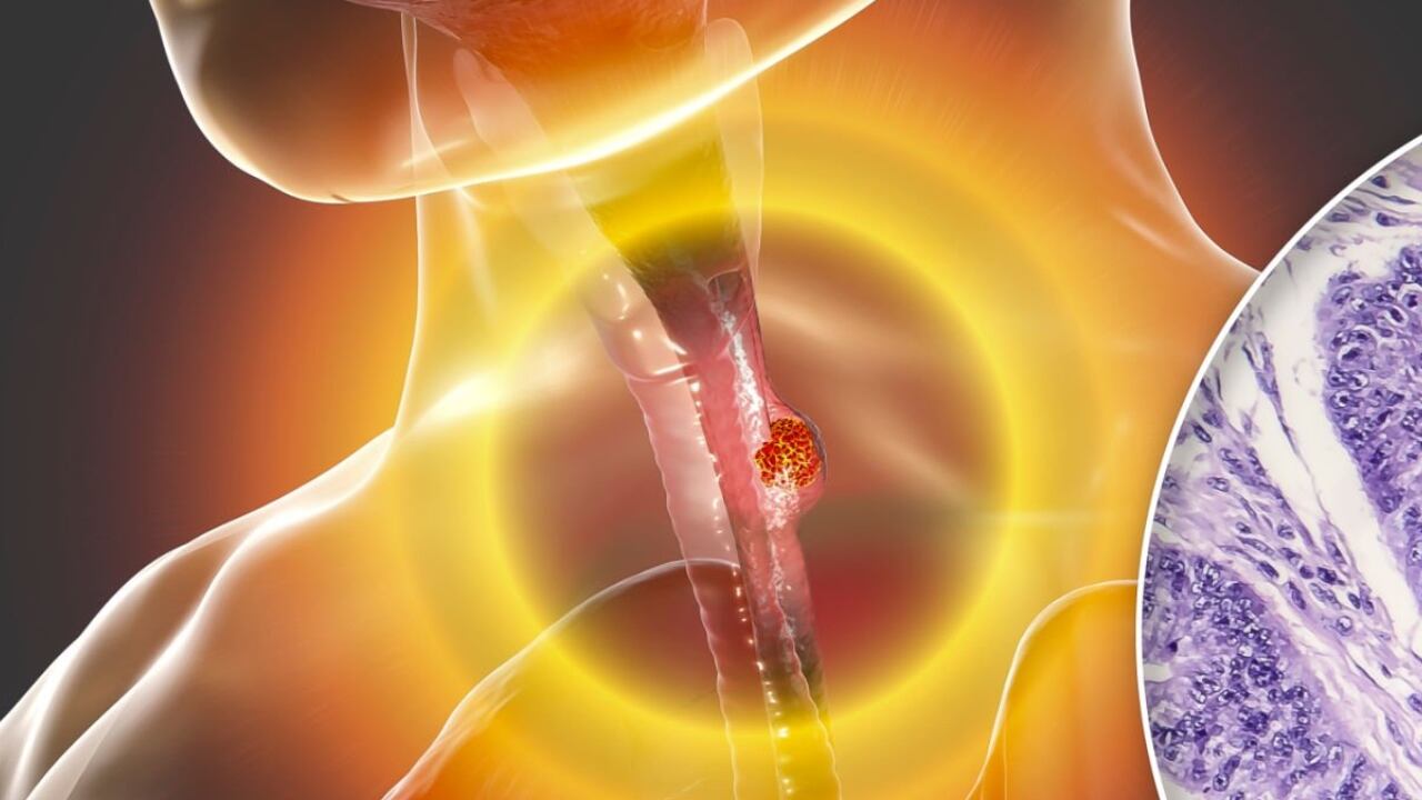 La mayoría de los nódulos en la tiroides no provocan ningún síntoma, solamente se presencia una pequeña bolita en el cuello.