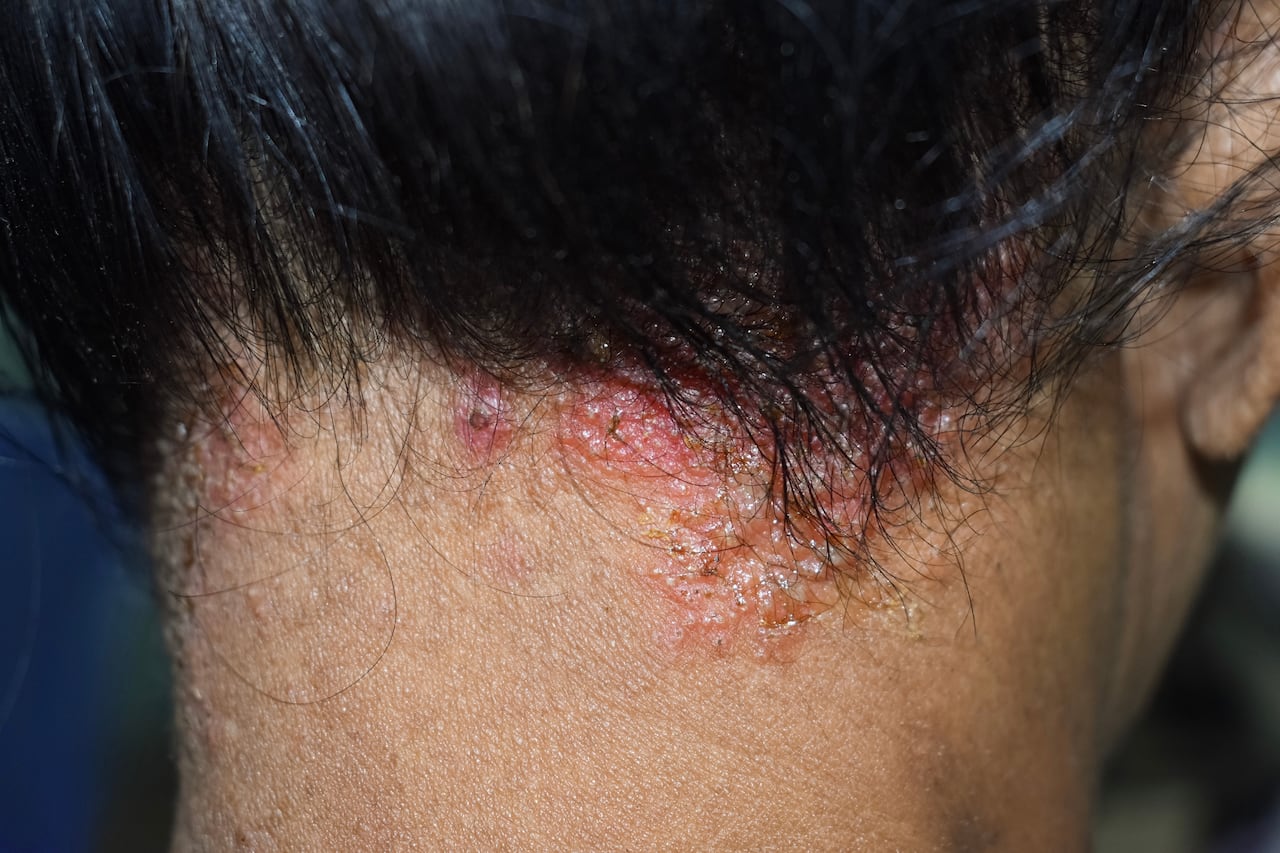 La tiña es una infección micótica.