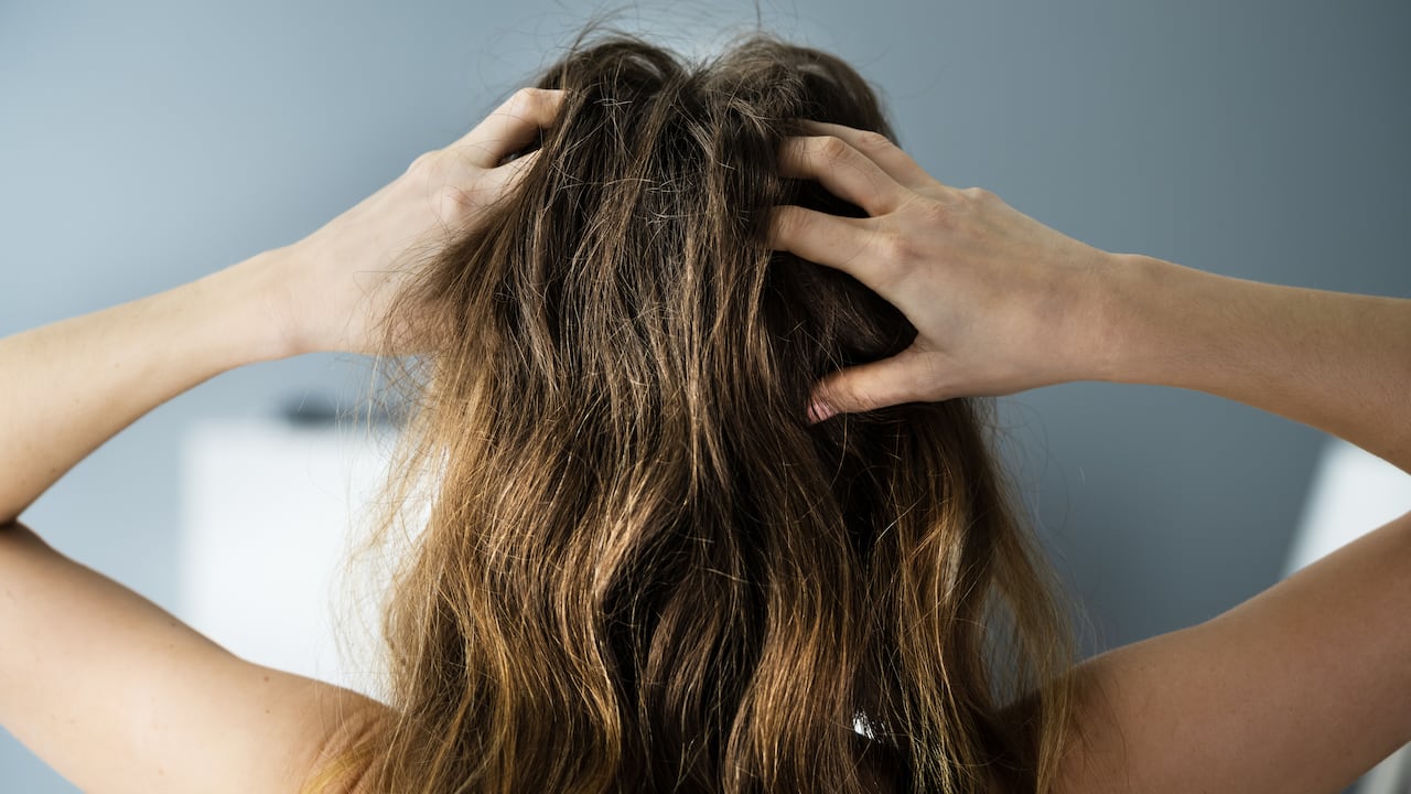 Itching Dry Head Scalp And Long Hair With Dandruff
