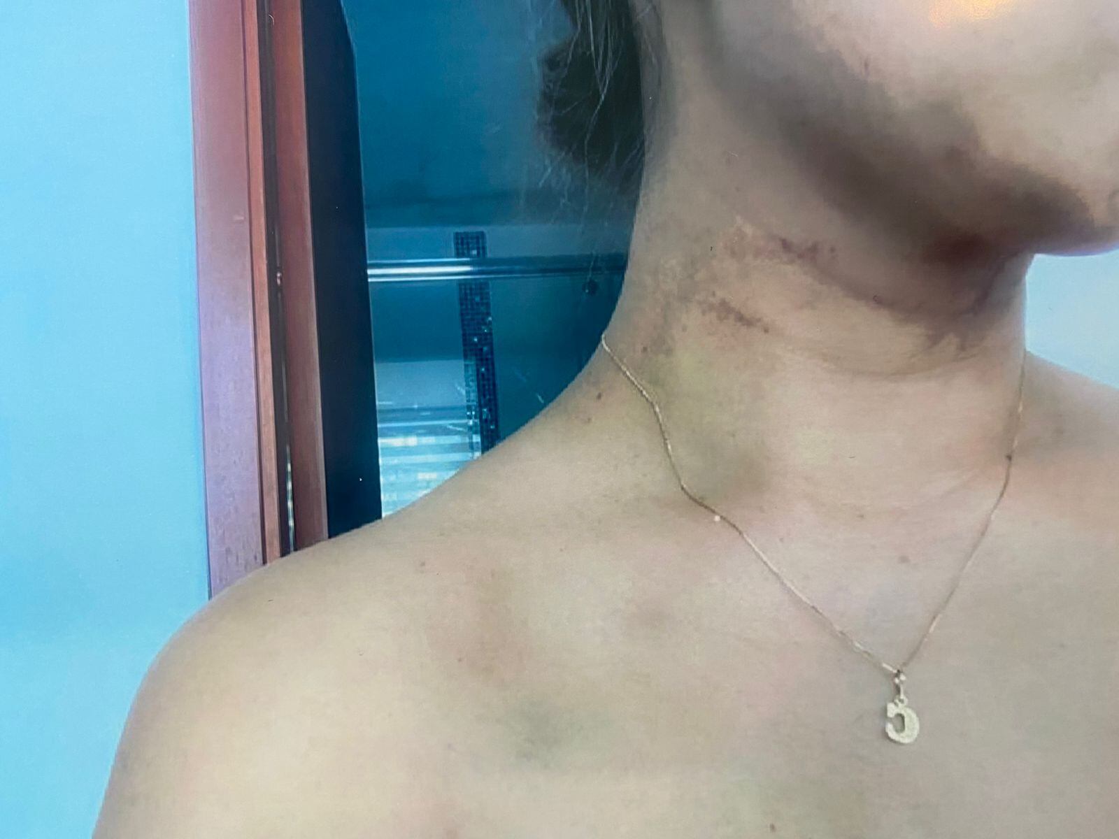 El aterrador relato de una anestesióloga atacada a mordiscos por su expareja sentimental, otro anestesiólogo