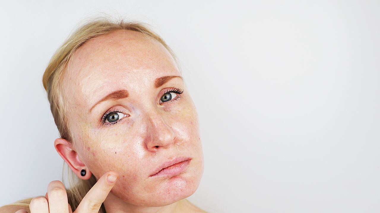 Portrait of a blonde girl with acne, oily skin and pigmentation. Oily and problem skin.