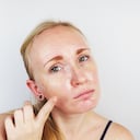 Portrait of a blonde girl with acne, oily skin and pigmentation. Oily and problem skin.