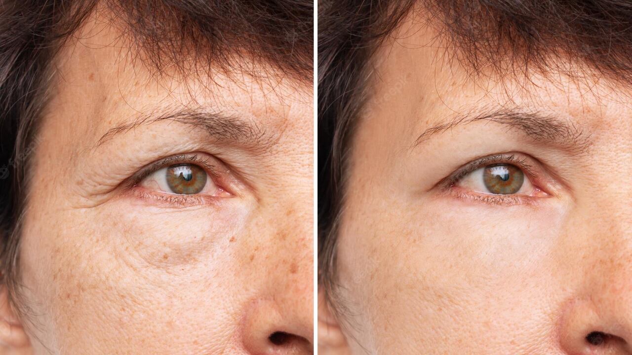 Remedios caseros para reducir las ojeras.