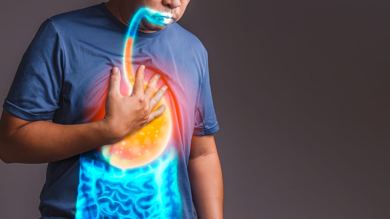 El reflujo gástrico puede darse por el consumo de algunos alimentos.