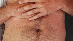 La movilidad durante la Semana Santa ha elevado el riesgo de expansión del virus, especialmente en estados como Chihuahua, Oaxaca, Sonora, Tamaulipas y Campeche.