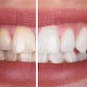 Los dientes pierden su color natural por diversos factores.