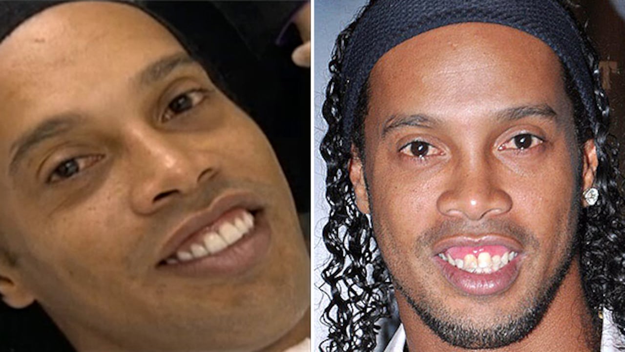 Esta es la comparación de como quedó y como era el jugador antes de la cirugía.