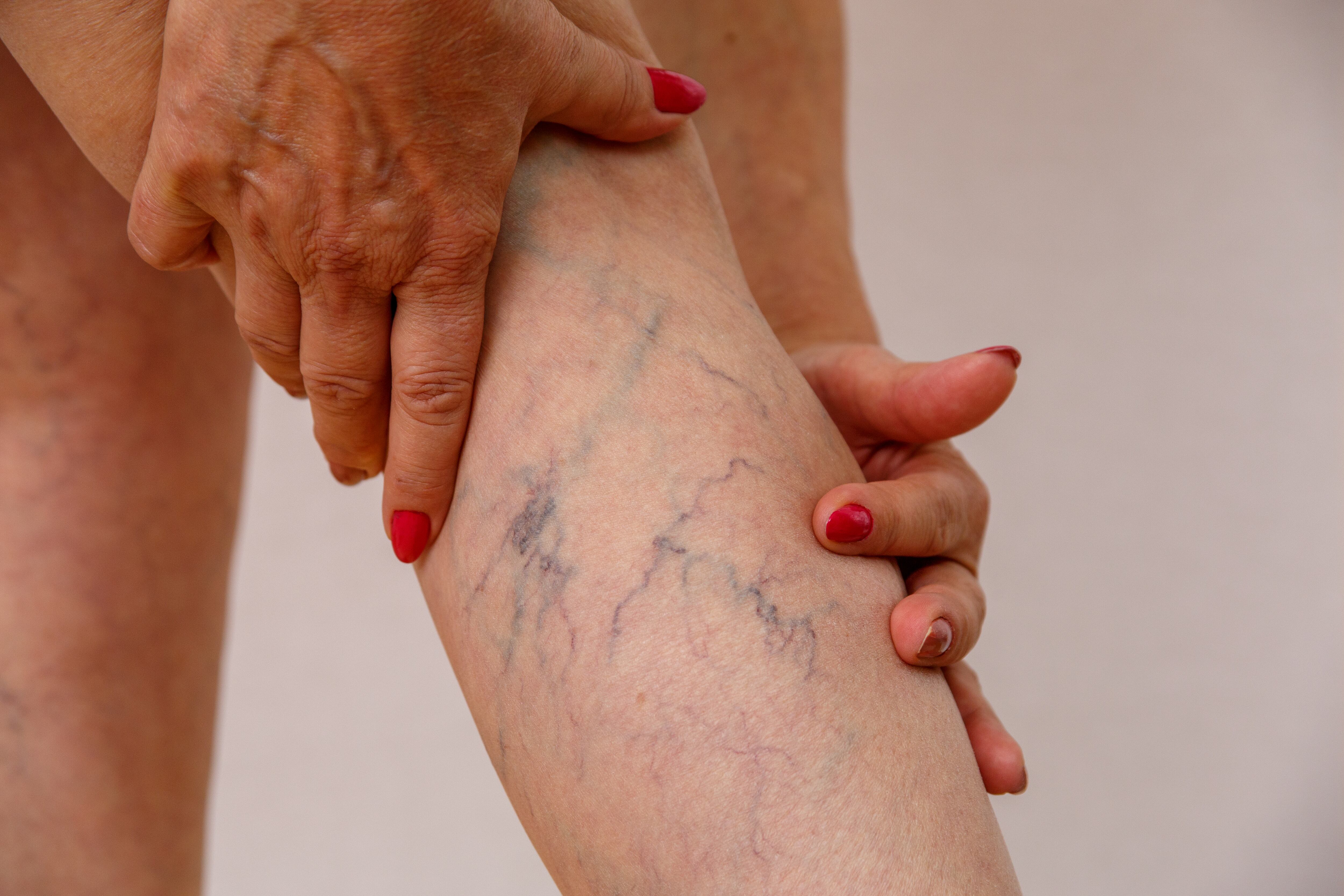 varicose veins of eldelry woman.