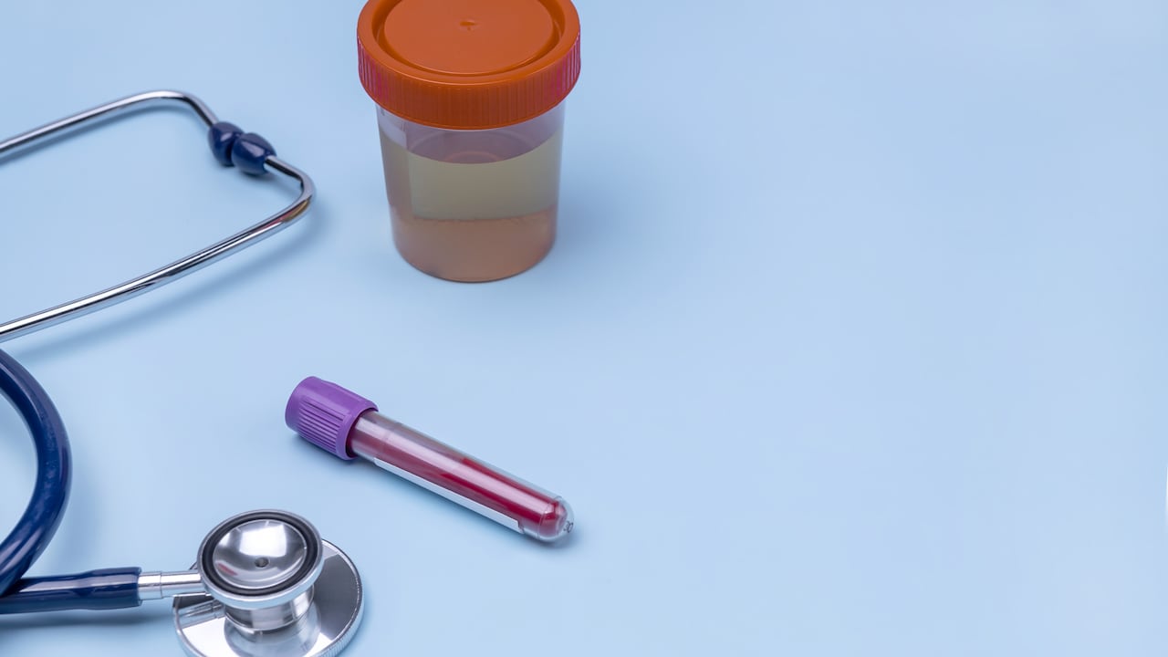 Análisis de sangre, análisis de orina, médico, prueba, sangre en la orina.