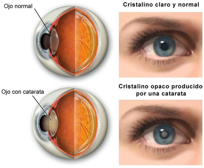 La diferencia entre un ojo con y sin catarata.